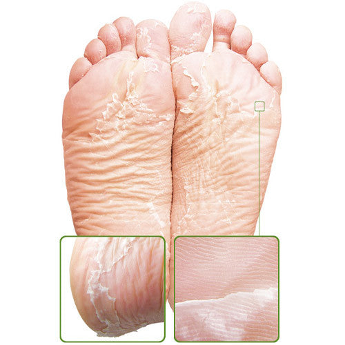 Foot Callus Remover Mask For Dead, Dry and Peeling Skin, Rough Heels Feet  Exfoliating Peel Scrub Results in Baby Soft, Silky, and Smooth Skin in 7-10