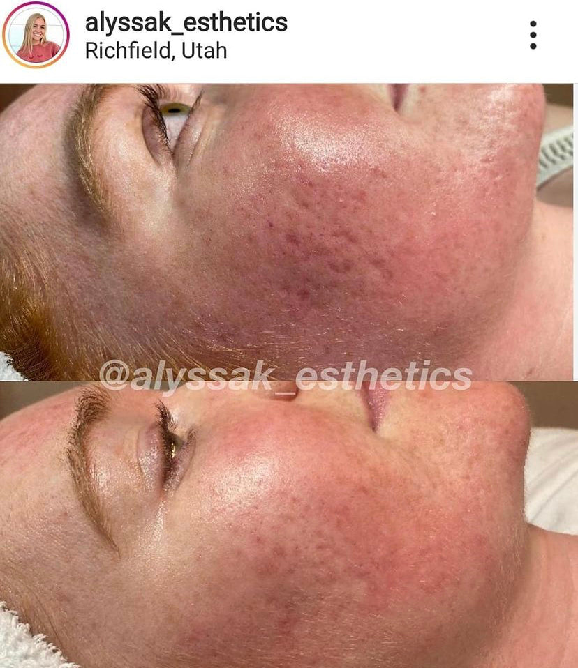 Microneedling Before And After Derma Pen Acne Scars Black Friday